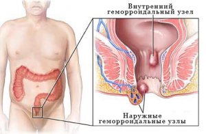 Як перемогти почечуй або як вилікувати геморой