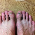 Cum să recunoști o ciupercă de unghii pe picioare