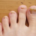 Як розпізнати грибок нігтів на ногах
