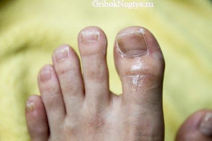 Як розпізнати грибок нігтів на ногах