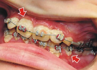 Як прибрати наліт на зубах у дитини чорний, коричневий, білий (фото)