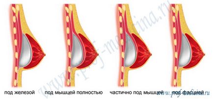 Cum să inserați implanturile mamare sub mușchi sau sub pieptul de mărire a sânilor