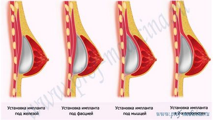 Cum să inserați implanturile mamare sub mușchi sau sub pieptul de mărire a sânilor