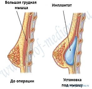 Cum să inserați implanturile mamare sub mușchi sau sub sânul de marire a sânilor