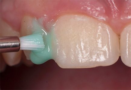 Carii dinților anteriori la tratament, preț, video, stomatologie