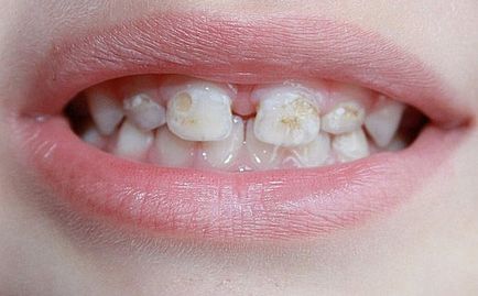 Карієс передніх зубів у дітей лікування, ціна, відео, лікування зубів