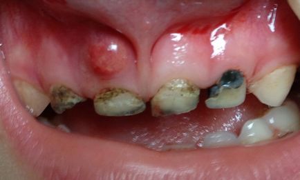 Кіста під зубом - чому виникає, як виявляється, чим небезпечна
