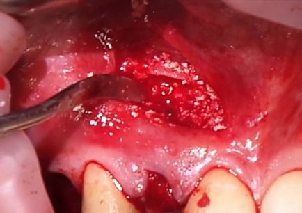Кіста під зубом - чому виникає, як виявляється, чим небезпечна