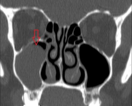 Cyst în sinus maxilar - fotografii, raze X, kt-imagini