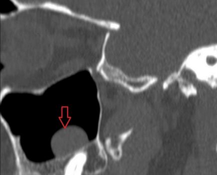 Cyst în sinus maxilar - fotografii, raze X, kt-imagini