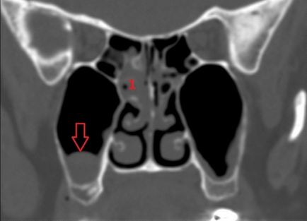 Cyst în sinus maxilar - fotografii, raze X, kt-imagini