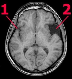 Chist în partea temporală, occipitală a capului, emisferele creierului