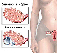 Chist ovarian - cauze, simptome, diagnostic și tratament