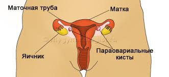 Chist ovarian la femeile de tipul, simptomele și tratamentul