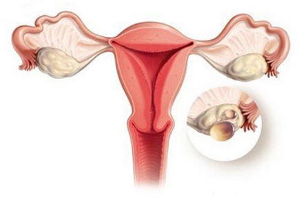 Chist ovarian la femeile de tipul, simptomele și tratamentul