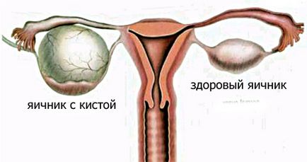 Tipuri de chisturi ovariene, simptome, tratament