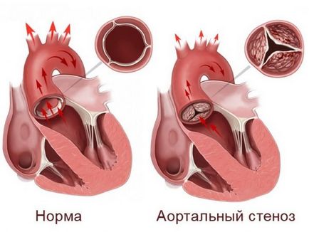 Stenoza valvulară sau îngustarea aortică la nou-născuți