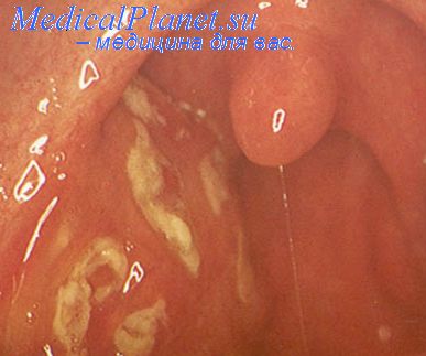Clinic krónikus mandulagyulladás (tonsillitis) Clinic krónikus mandulagyulladás