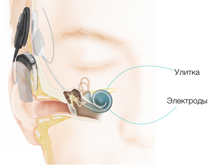 Кохлеарний імплант cochlear особливості та технології