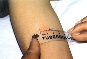 Testarea cantitativă pentru tuberculoză în vitro ceea ce este și modul în care este efectuată