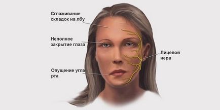 Fizioterapia cu nevrită a nervului facial