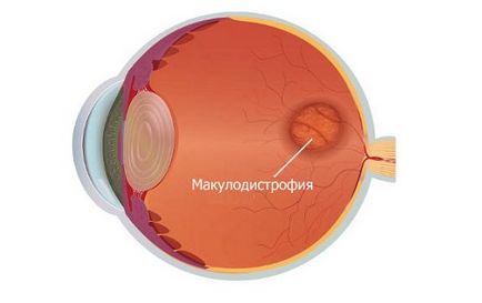 Kezelése retinadisztrófiában konzervatív, és sebészetileg