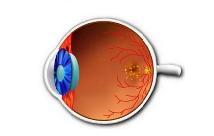 Tratamentul distrofiei retinale conservator și chirurgical