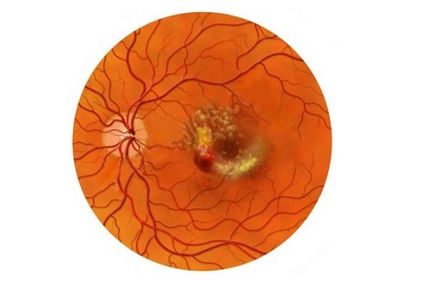Tratamentul distrofiei retinale conservator și chirurgical