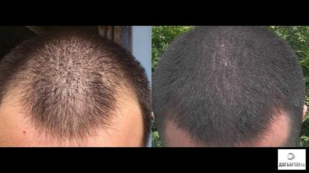 Tratamentul alopeciei