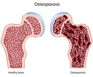 Tratamentul osteoporozei în Israel prețuri, recenzii, prețuri