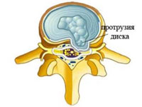 Лікування протрузії дисків хребта чим і як лікувати, вправи (ЛФК)