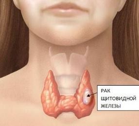 Tratamentul cancerului tiroidian cu remedii folclorice
