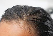 Лікування себореї в домашніх умовах - народні рецепти - клініка лікування волосся в москві