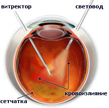 Tratamentul retinei