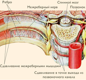 міжреберна невралгія