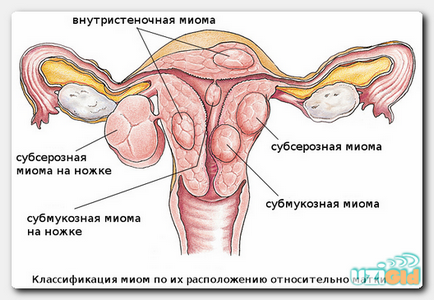 Myoma uzi pelvis mic în timpul sarcinii, diagnostic