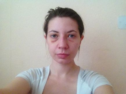 Diuretice pentru edem facial