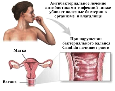 Молочниця у жінок причини лікування