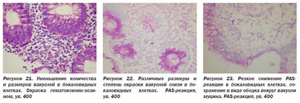 Morfológiai diagnózis colitis ulcerosa, egy online kiadvány - hírek az orvostudomány (nem-specifikus) Morfológiai diagnózis colitis ulcerosa, egy online kiadvány - orvosi hírek