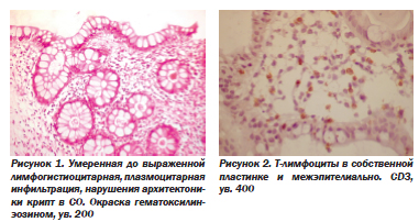 Diagnosticul morfologic al colitei ulcerative nespecifice, ediția online - știri de medicină