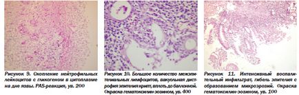 Morfológiai diagnózis colitis ulcerosa, egy online kiadvány - hírek az orvostudomány (morfológiai) Morfológiai diagnózis colitis ulcerosa, egy online kiadvány - orvosi hírek