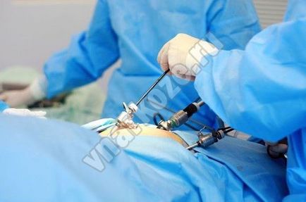 Anestezia cu laparoscopie - laparoscopie sub anestezie locală