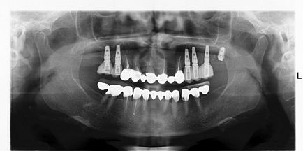 Implantarea imediată în regiunea primului molar drept al maxilarului inferior, folosind