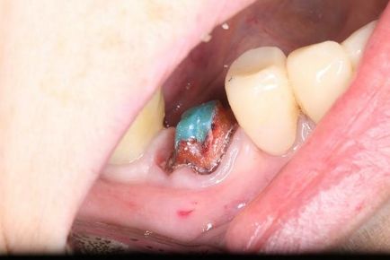 Implantarea imediată în regiunea primului molar drept al maxilarului inferior, folosind