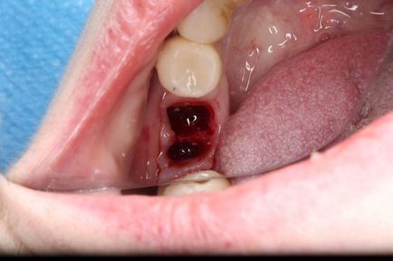 Implantarea imediată în regiunea primului molar drept al maxilarului inferior, folosind