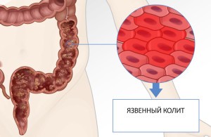 Fekélyes vastagbélgyulladás kezelésére, élelmiszer