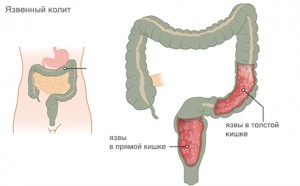 Fekélyes vastagbélgyulladás kezelésére, élelmiszer