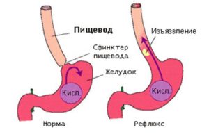 Омепразол від печії