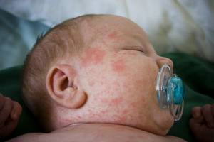 Veszélyes betegség a gyermekek a legveszélyesebb gyermekkori betegségek, a 21. század