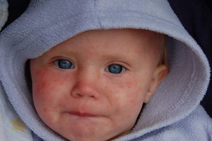 Небезпечні захворювання у дітей найнебезпечніші дитячі захворювання 21 століття